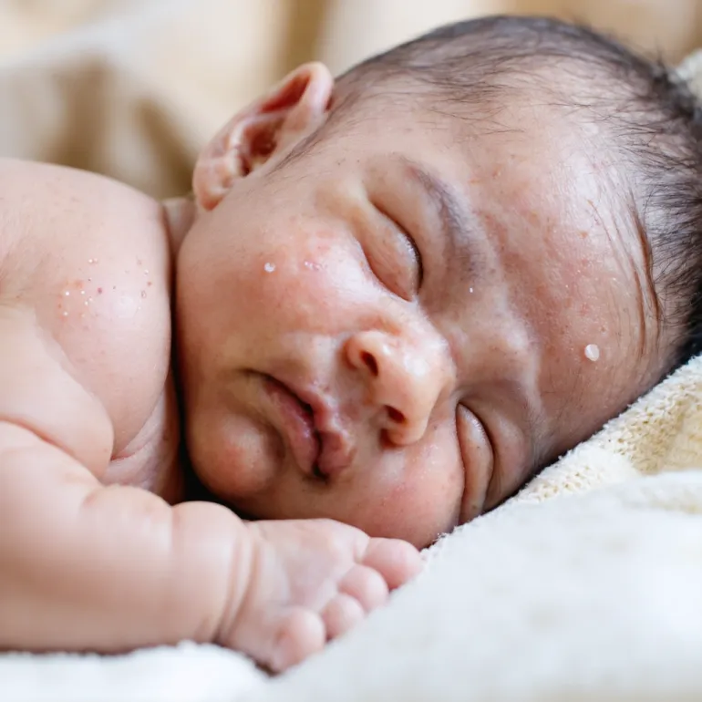 Акне новорожденных форум: подробная инструкция и важные нюансы